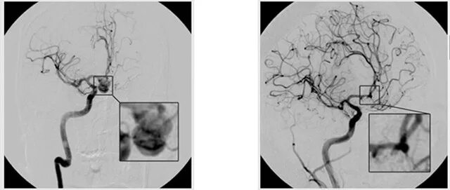 Операция аневризма сосудов головного мозга. Клипирование аневризмы сосудов. Аневризма головного мозга клипирование. Эмболизация аневризмы сосудов головного мозга.