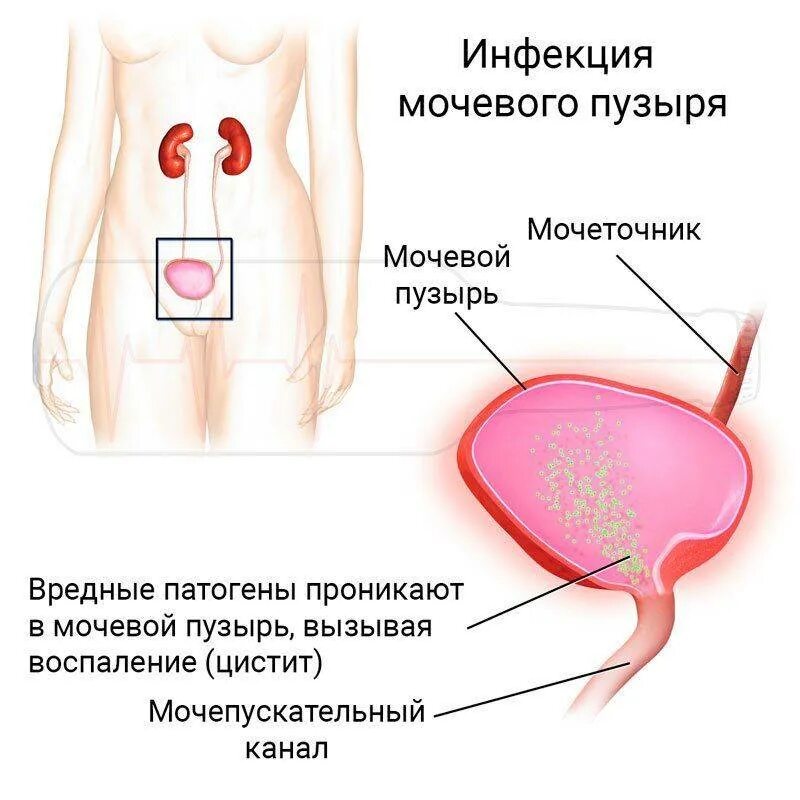 Воспаление мочевого пузыря у женщин лечение. Таблетки при воспалении и инфекции мочевого пузыря. цистит воспаление мочевого пузыря.