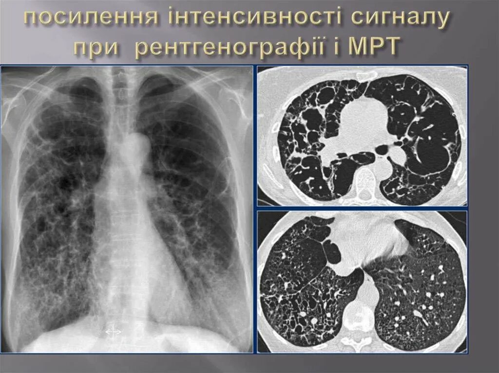 Интерстициальное поражение легких. Идиопатический пневмонит. Интерстициальная болезнь легких рентген. Интерстециальныезабоевания лёгки рентген. Фиброзирующий альвеолит (синдром Хаммена-Рича)..