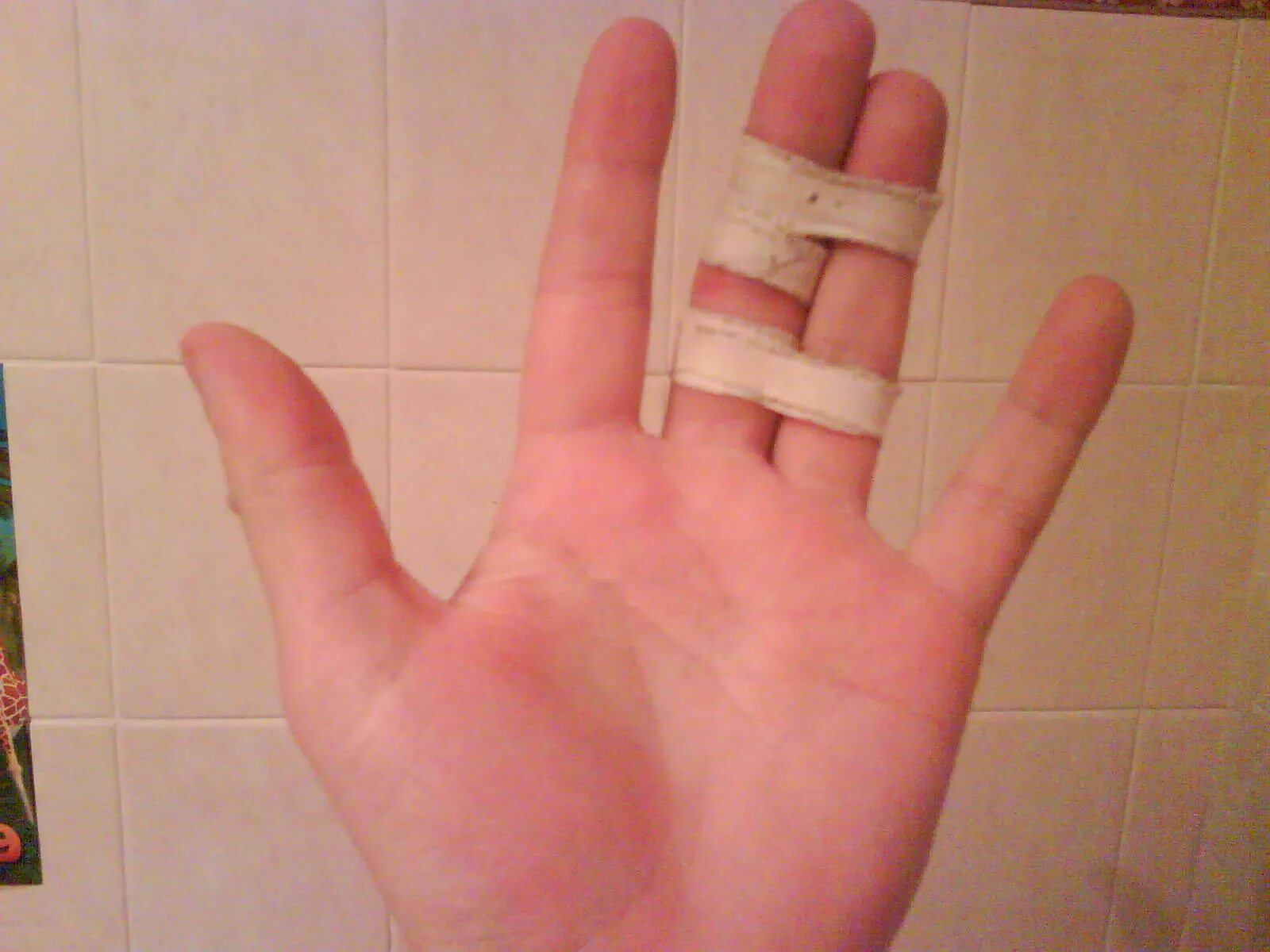 выбил средний палец. выбил средний палец. выбил средний палец. выбил средний палец. перелом фаланги безымянного пальца.