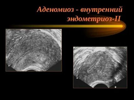 Эхопризнаки внутреннего эндометриоза