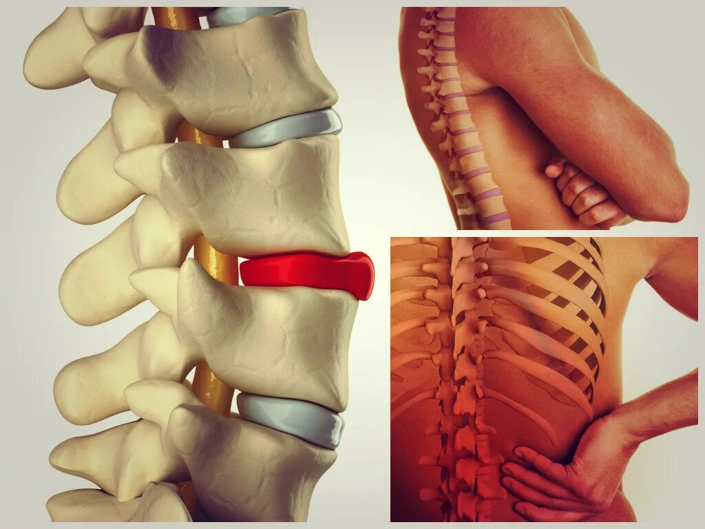 Симптомы межпозвоночной грыжи. Междисковая грыжа позвоночника. Грыжи и протрузии позвоночника. Межпозвоночная грыжа поясничного отдела. Спинно позвоночная грыжа.