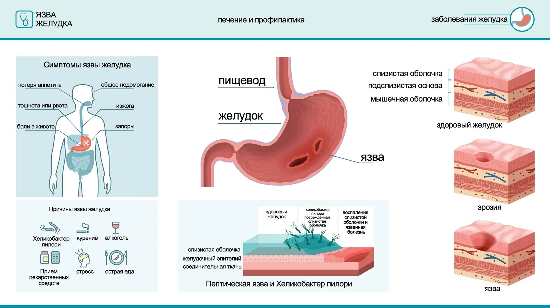 Заболевания желудка человека. Язвенная болезнь желудка и 12-перстной кишки. Гастрит.. Сопутствующие заболевания при язвенной болезни желудка. Стадии развития язвенной болезни желудка. Симптомы язвенной болезни желудка и двенадцатиперстной кишки.