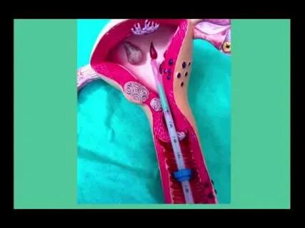 Мирена установка видео