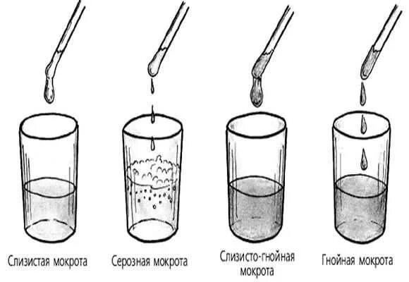 Гнойный характер мокроты. Мокрота схема. Слизисто гнойная мокрота. Консистенция мокроты.