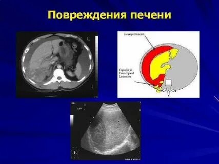 Повреждение печени характерно для