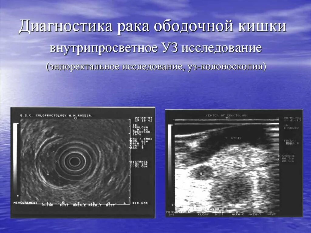 Исследование ободочной кишки. Диагноз опухоли ободочной кишки. Методы исследования ободочной кишки. Эндоскопическое ультразвуковое исследование ободочной кишки. Мкб слепой кишки