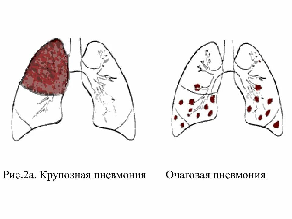 Крупозная и очаговая пневмония. Крупозная пневмония и очаговая пневмония. Крупозная пневмония (2-я стадия);. Очаговая и корпусная пневмония. Острое поражение легких