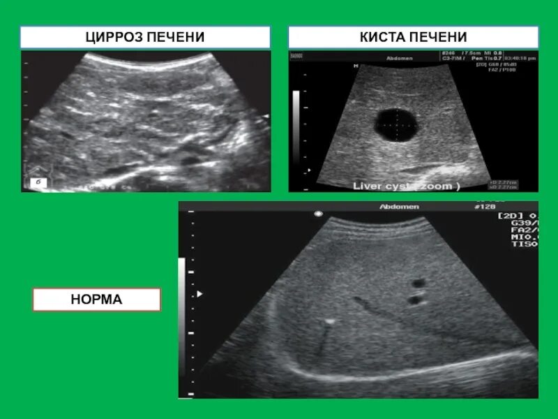 Простая киста печени. Небольшие кисты в печени.