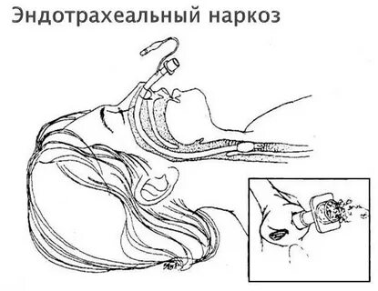 Что такое эндотрахеальный наркоз