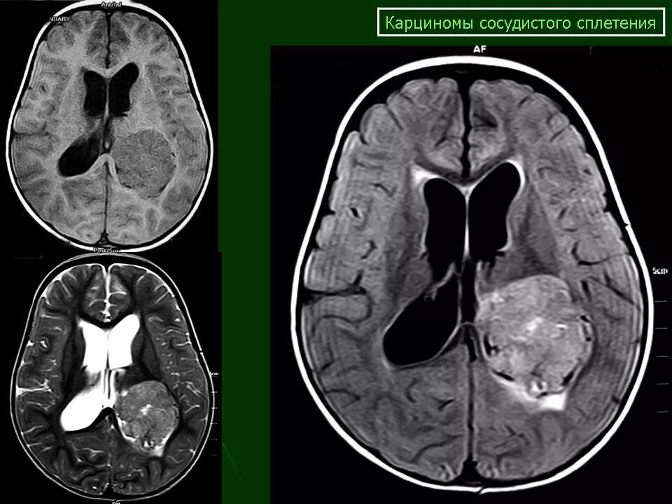 Опухоли желудочков. Опухоль сосудистого сплетения бокового желудочка мрт. Объемное образование сосудистого сплетения. Папилломы сосудистого сплетения кт. Образование сосудистого сплетения бокового желудочка.