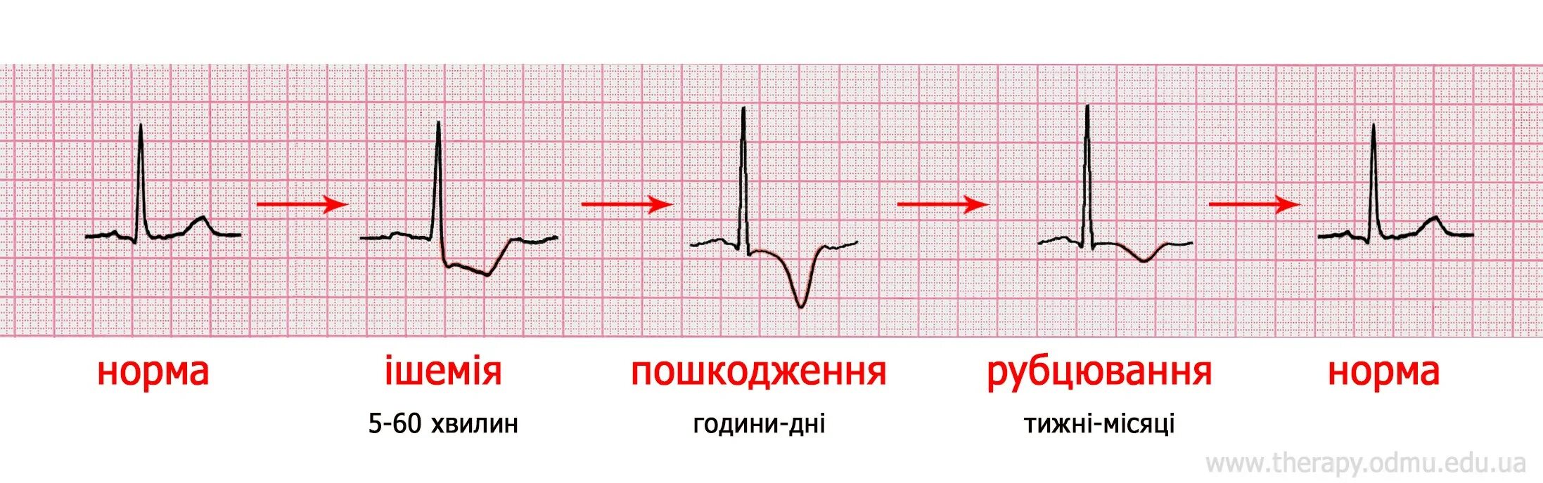 Ишемический подъем st
