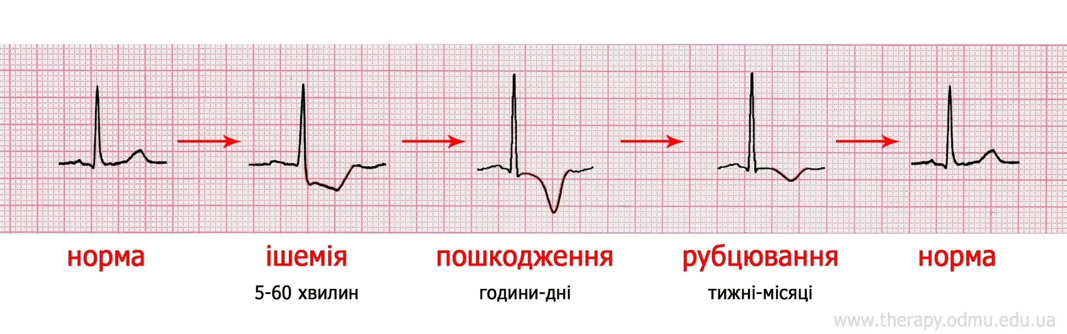 Эпизод депрессии st. Элевация сегмента St на ЭКГ. Элевация St в v1-v3. Элевация сегмента St при инфаркте миокарда. Корытообразная депрессия сегмента St на ЭКГ.