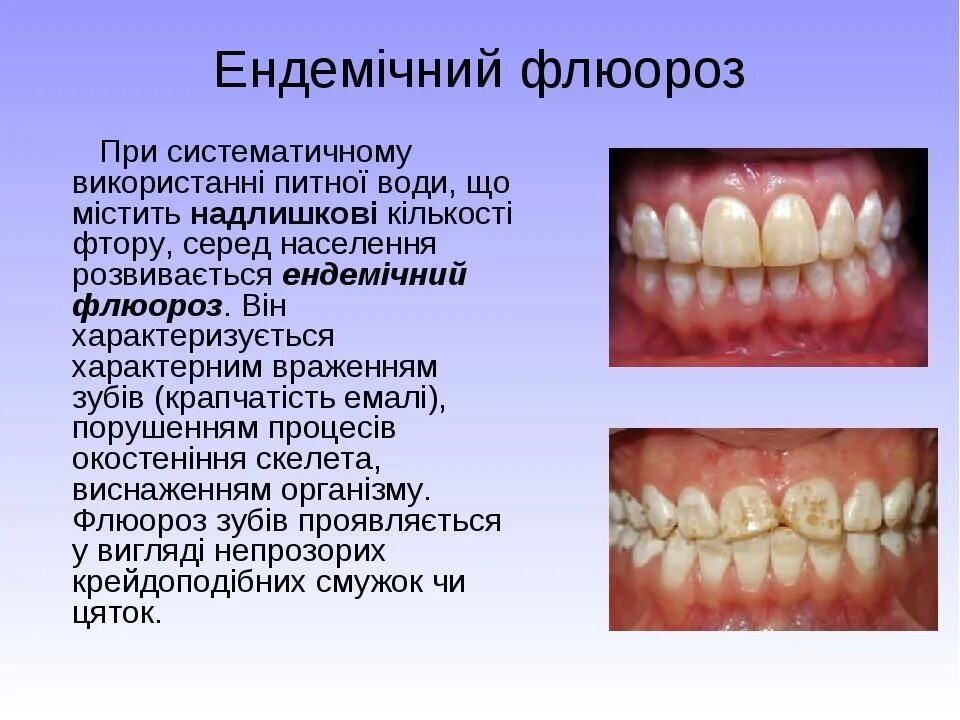 Классификация флюороза