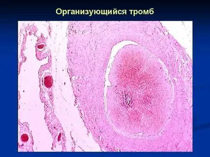 Канализация тромба