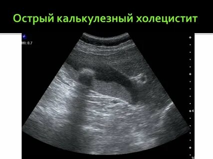Узи почек и желчного пузыря