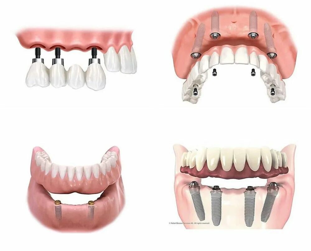 минусы имплантации зубов. схема установки зубных имплантов. импланты зубов схема. памятка по имплантации зубов. одноэтапная имплантация зубов.