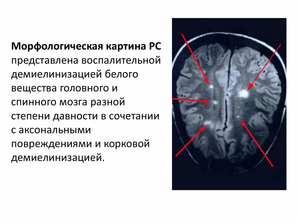 Рассеянный склероз спинного мозга. Очаги склероза в головном мозге. Концентрический склероз. Демиелинизация головного
