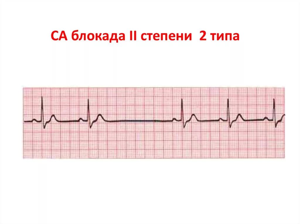 Синоаурикулярная блокада. Са блокада 2 степени на ЭКГ. Са блокада 2 степени 2 типа на ЭКГ. Синоаурикулярная блокада 2 степени 2 типа на ЭКГ. Сино-атриальная блокада 2 степень ЭКГ.