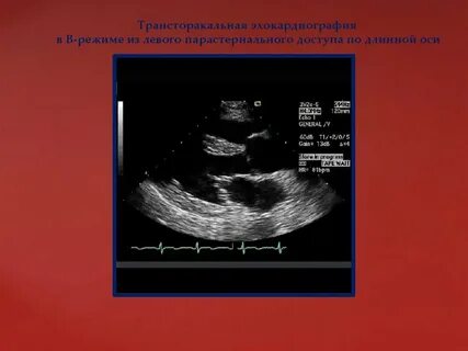 Корригированная транспозиция магистральных