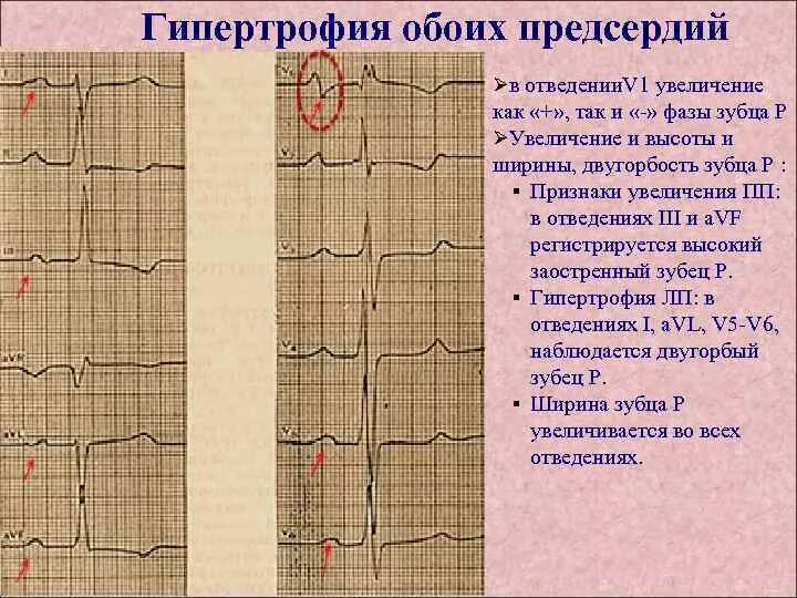 Гипертрофия предсердий. Экг - синдром гипертрофии предсердий.. гипертрофия правого предсердия v1 v2. экг при гипертрофии миокарда левого предсердия. двугорбый зубец на экг.