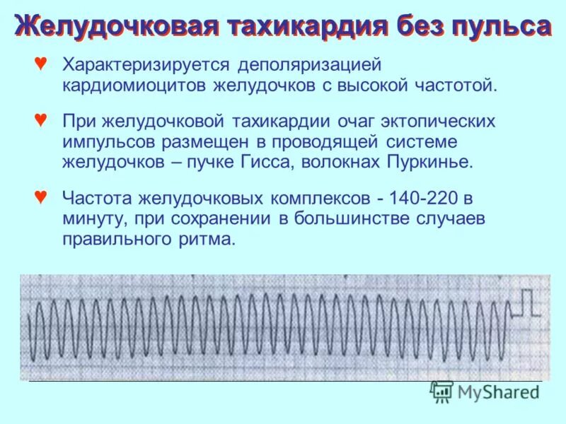 фибрилляция желудочков без пульса экг. мономорфная желудочковая тахикардия экг. признаком пароксизмальной желудочковой тахикардии является. беспульсовая желудочковая тахикардия. тахикардия без пульса.