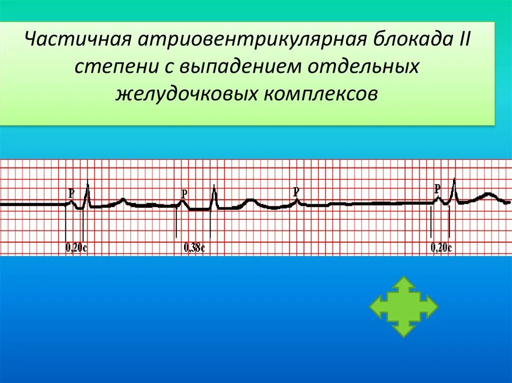 Атриовентрикулярная блокада 2. АВ блокада 2 степени без выпадения комплекса. Атривентрикулярной блокада. Атриовентрикулярная блокада степени. Полная АВ блокада 2 степени.