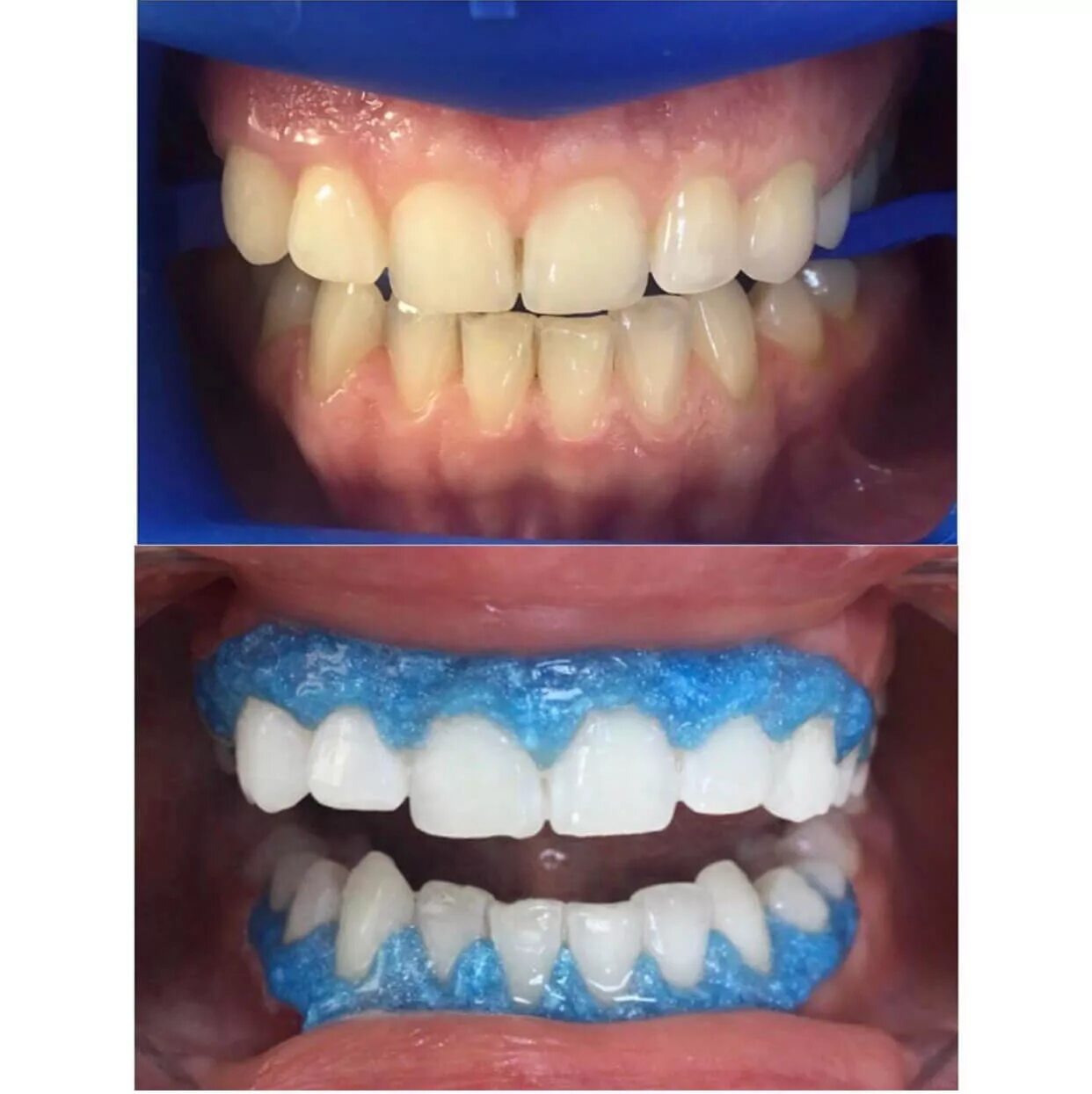 Лазерное отбеливание отзывы. Отбеливание зубов до и после. Отбеливание ЗУ.ов результат. Профессиональное отбеливание зубов до и после.