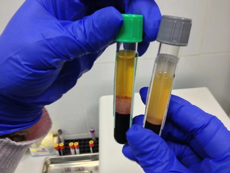 Сыворотка крови плазма крови расшифровка. Плазменная металлургия. Показатель рн плазмы крови отражает. Причины возникновения зарядов в плазме. Плазменные процессы предмет исследования.