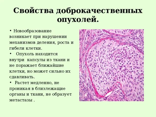 Клетка доброкачественной опухоли. Новообразования опухоли. Свойства доброкачественных опухолей. Характеристика доброкачественных опухолей. Новообразование возникает при ?.