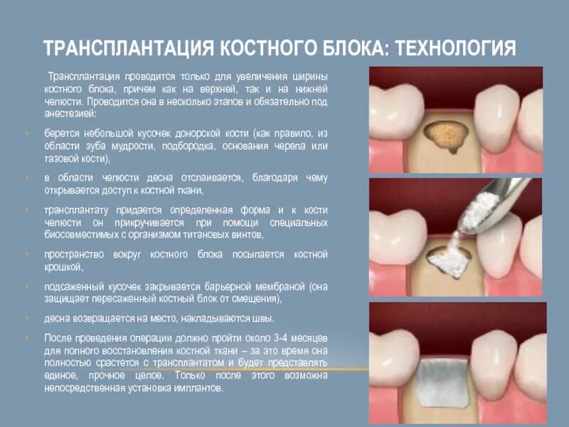 Подсадка костной
