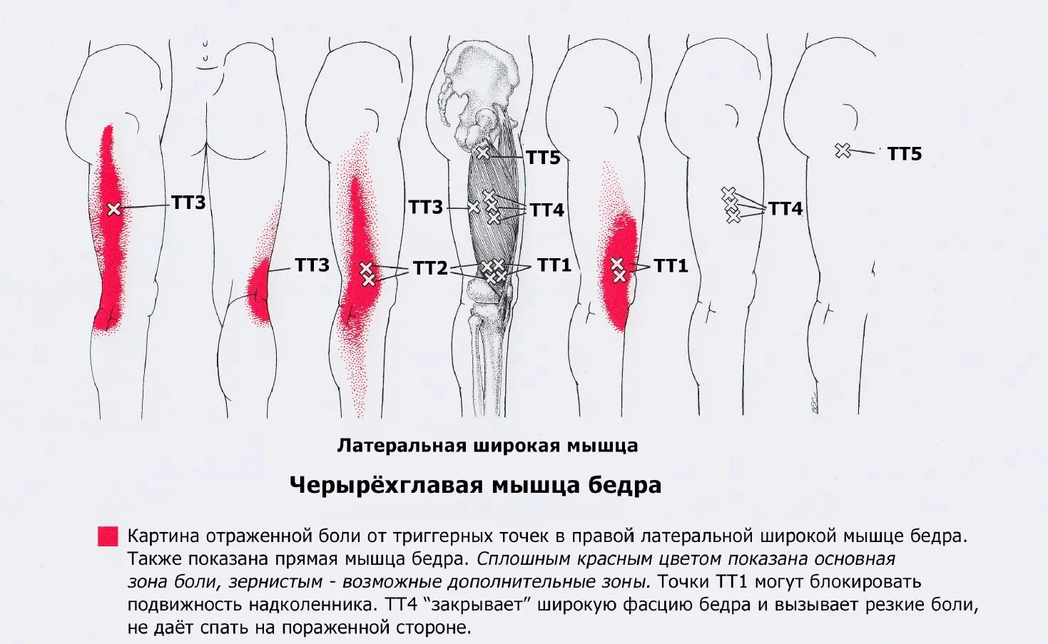 Боль в бедре с внешней стороны. Боль в правой ноге от ягодицы до ступни. Боль в ногах с красной отметкой зоны.