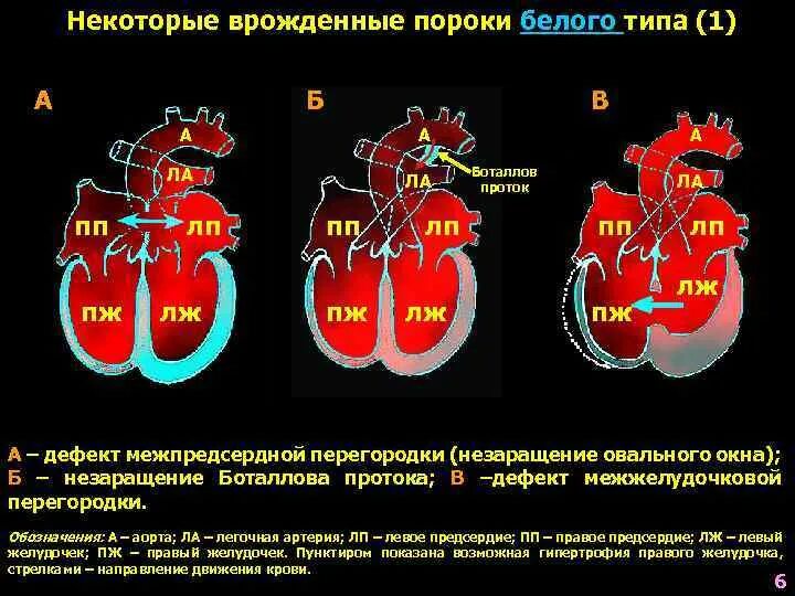 Врожденные пороки сердца белого типа. Бледный порок. Группа здоровья порок сердца. Врожденные пороки сердца у детей бледного типа. Бледный порок.