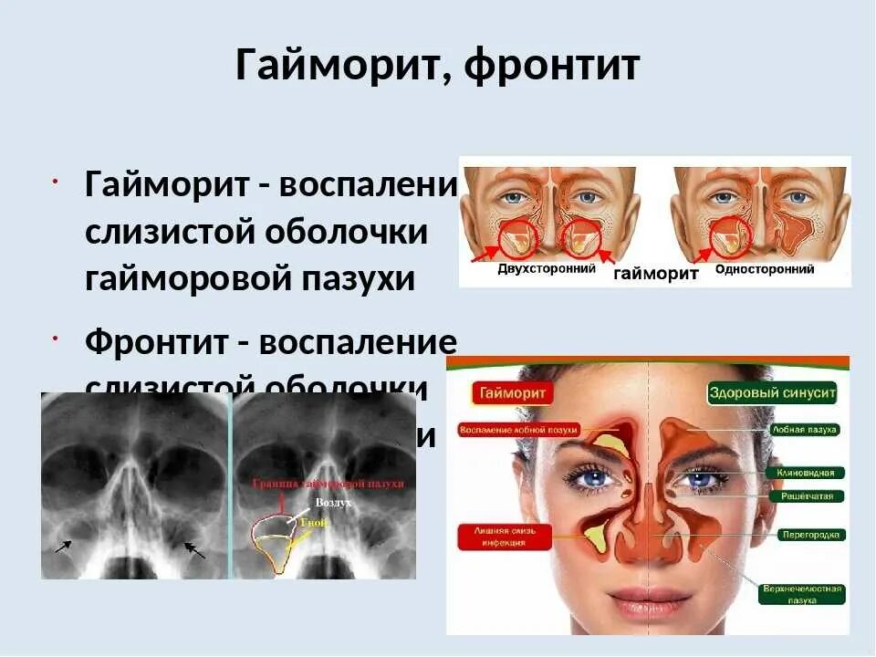 Болезни связанные с носом. Фронтит гайморит пазухи. Фронтит воспаление верхнечелюстной пазухи. Фронтит воспаление лобной пазухи. Синусит лобной пазухи фронтит.