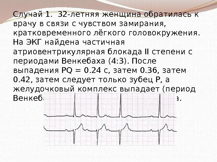 Внутрипредсердная блокада сердца ЭКГ. Блокада волокон Пуркинье на ЭКГ. Кардиограмма при блокаде сердца. Внутрипредсердная блокада 1 степени на ЭКГ что это такое.