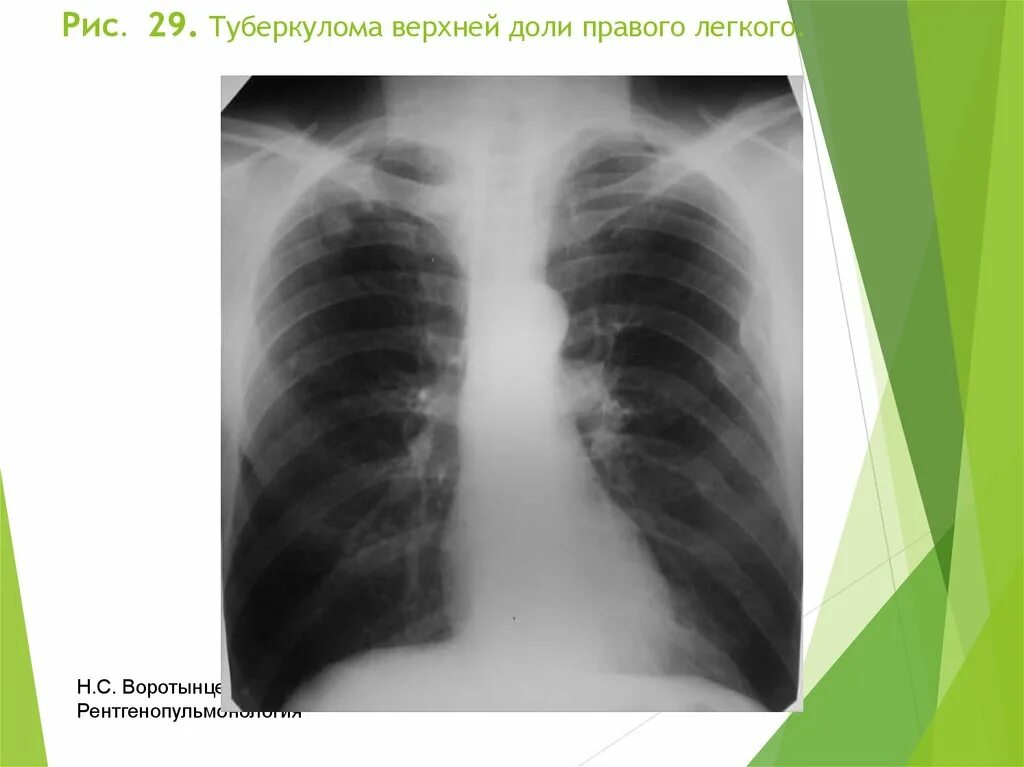 Туберкулома верхней доли правого легкого. Очаговые тени в легких на рентгене. Туберкулома легкого рентген. Очаговая тень в легком на рентгене.