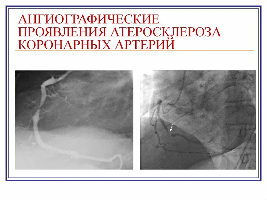 Тромбоз коронарных артерий. Атеросклеротическое поражение ствола коронарных артерий. Ангиография окклюзия коронарных артерий. Синдром атеросклероза коронарных артерий. Коронарография при атеросклерозе коронарных артерий.