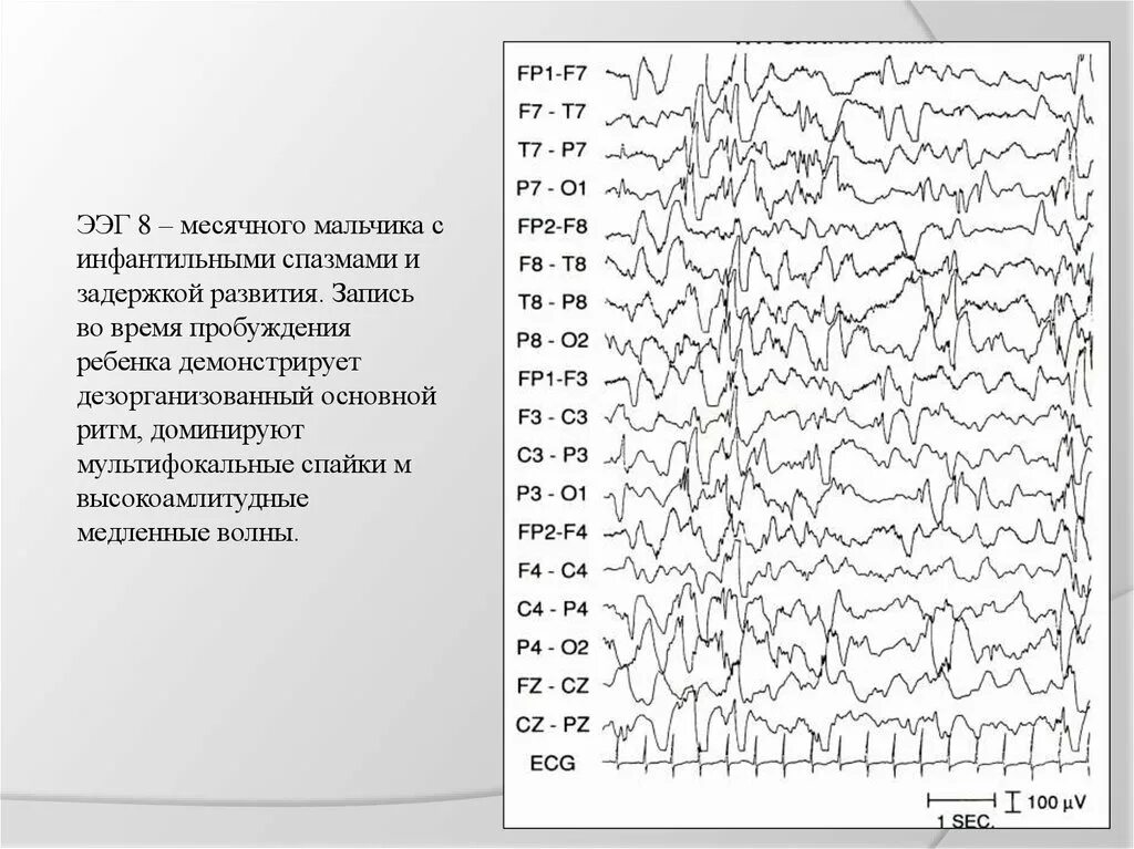 Дезорганизованный тип ээг. Каппа ритм ЭЭГ. ЭЭГ показания. Характеристики ЭЭГ. Опишите основные ритмы ЭЭГ..