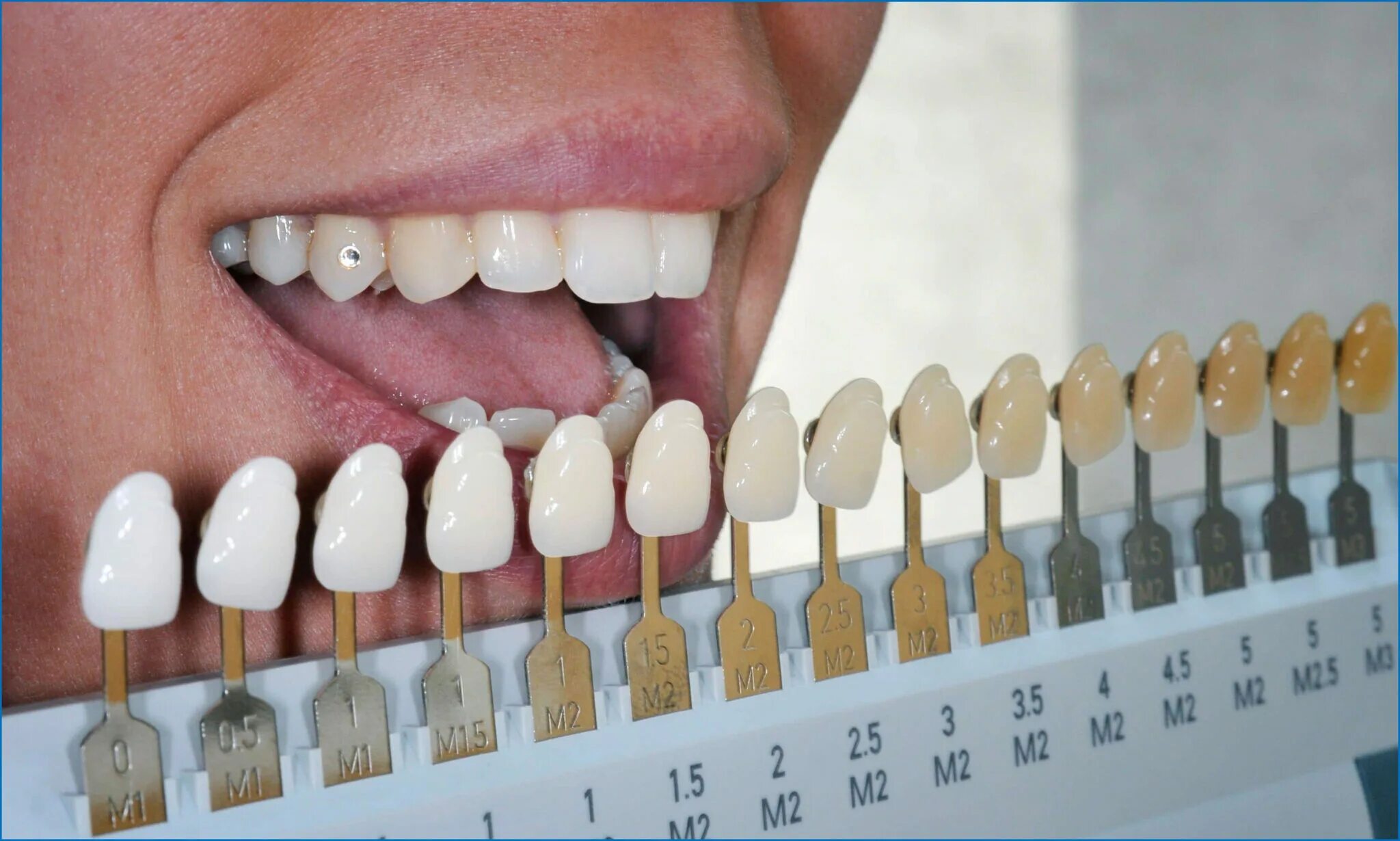 Шкала для определения цвета зубов. Определение цвета зуба. Шкала цветов зубов. Шкала цвета зубов. Определение цвета зуба.