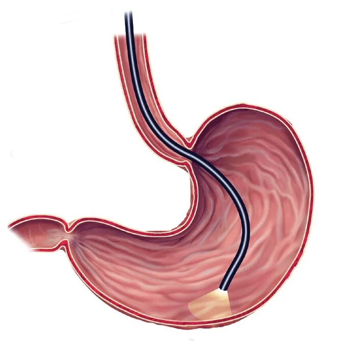 Эфгдс что это такое. Двенадцатиперстная кишка ФГДС. Язва двенадцатиперстной кишки ФГС. Гастроскопия желудка гастрит. Эндоскопическое исследование желудка и двенадцатиперстной кишки.