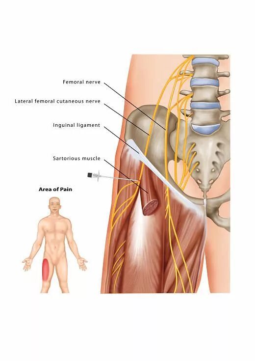 Латеральный кожный нерв бедра. Парестетическая мералгия. Неврит наружного кожного нерва бедра. Бедренный нерв (nervus femoralis).