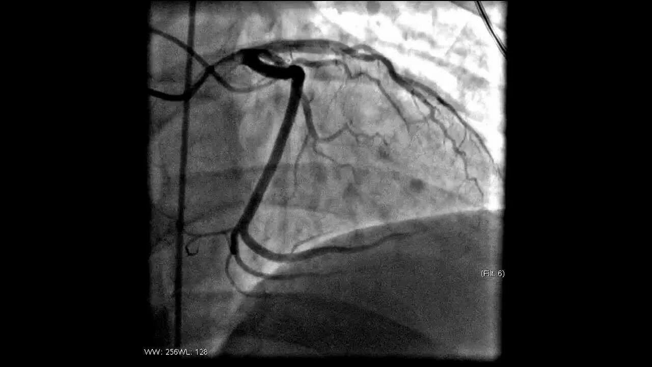 Стентирование видео. Инфаркт на коронарографии. Коронарография сосудов. Коронарография при инфаркте миокарда.
