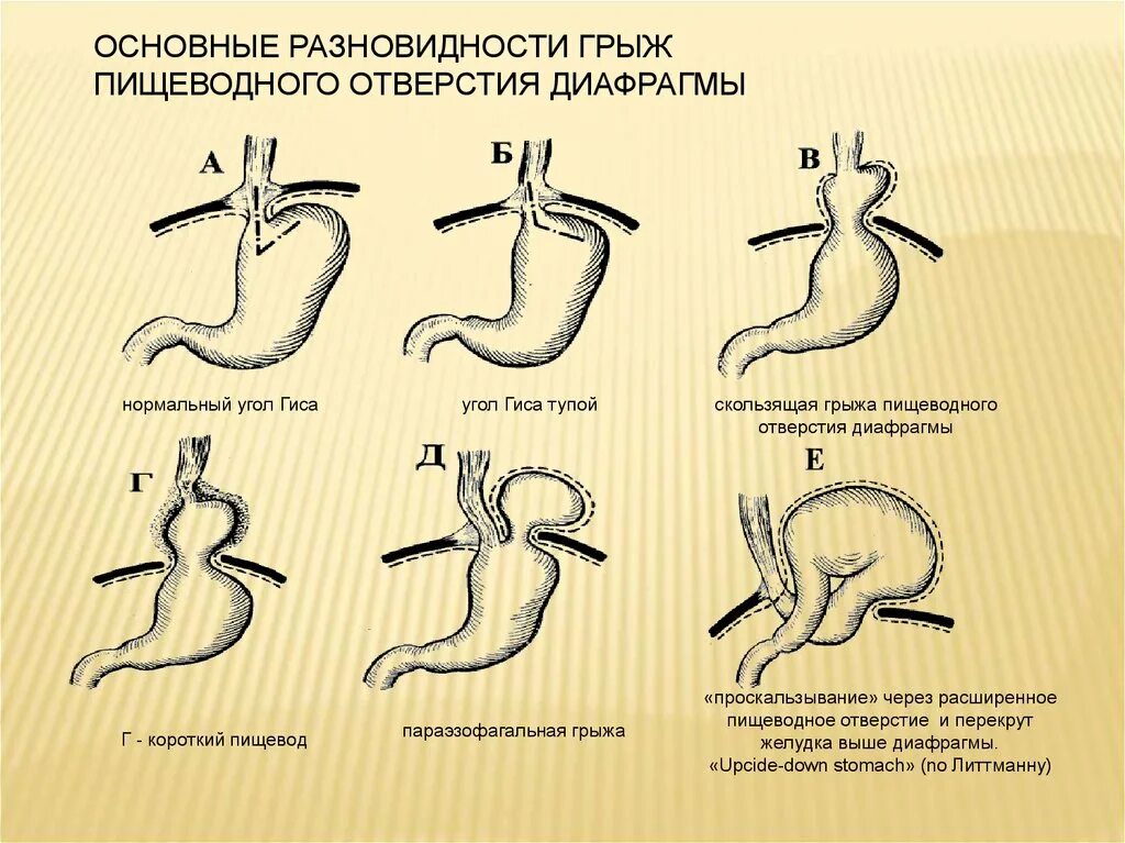 Диафрагмальный пищевода