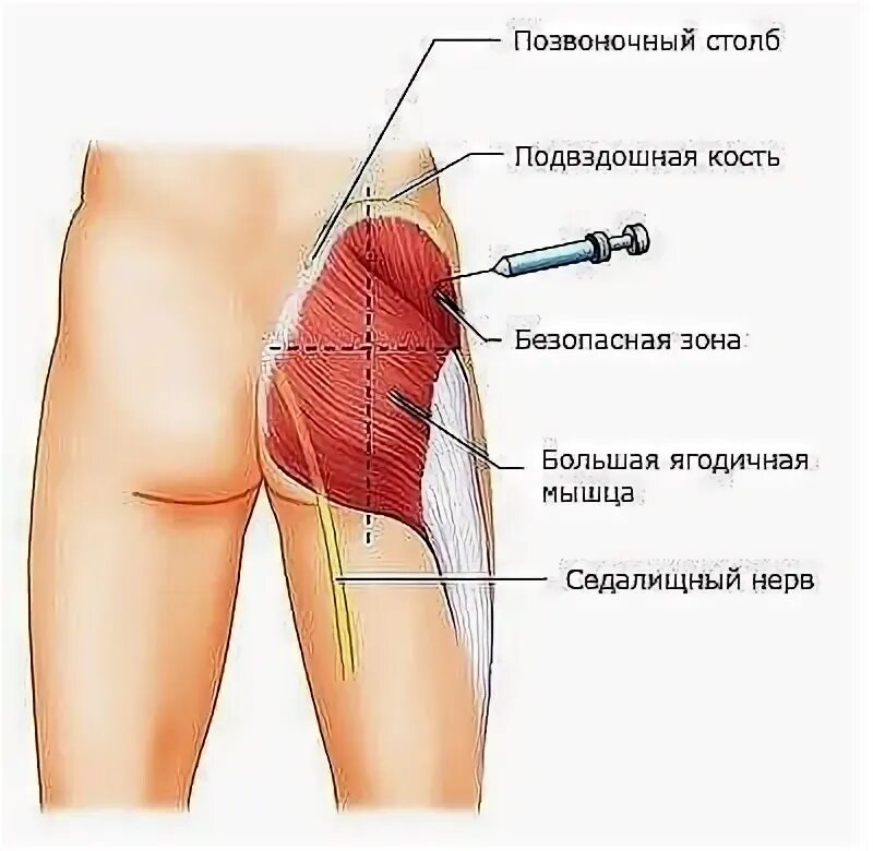 Как выбрать место для внутримышечного укола? Укол в мышцу: как выбрать место на 