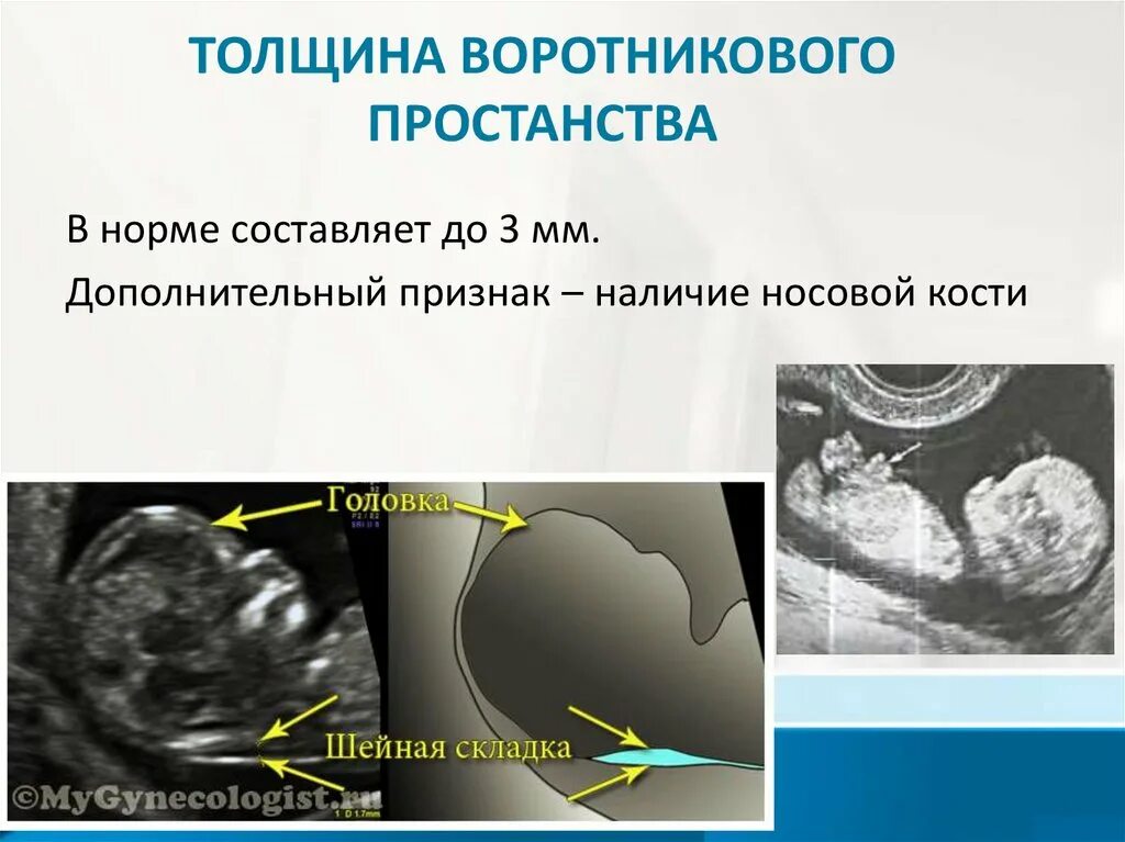 ТВП И носовая кость. Толщина носовой кости в 12 недель. Нормы УЗИ В 13 недель носовая кость. Норма в 15 недель носовая кость и воротниковое пространство. Кости в 13 недель