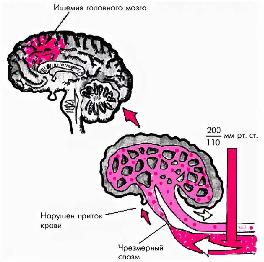 Нарушен приток крови к голове. Транзиторная ишемия головного мозга макропрепарат. Транзиторная ишемия головного мозга морфология.