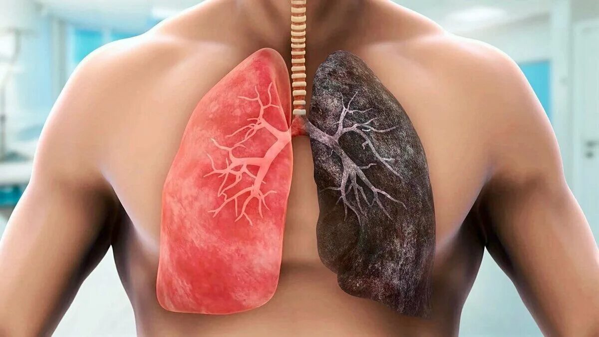 Частые болезни легких. Лёгкие здорового человека и курильщика. Легкие курящего человека.