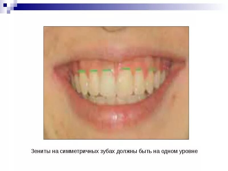 Симметричные зубы