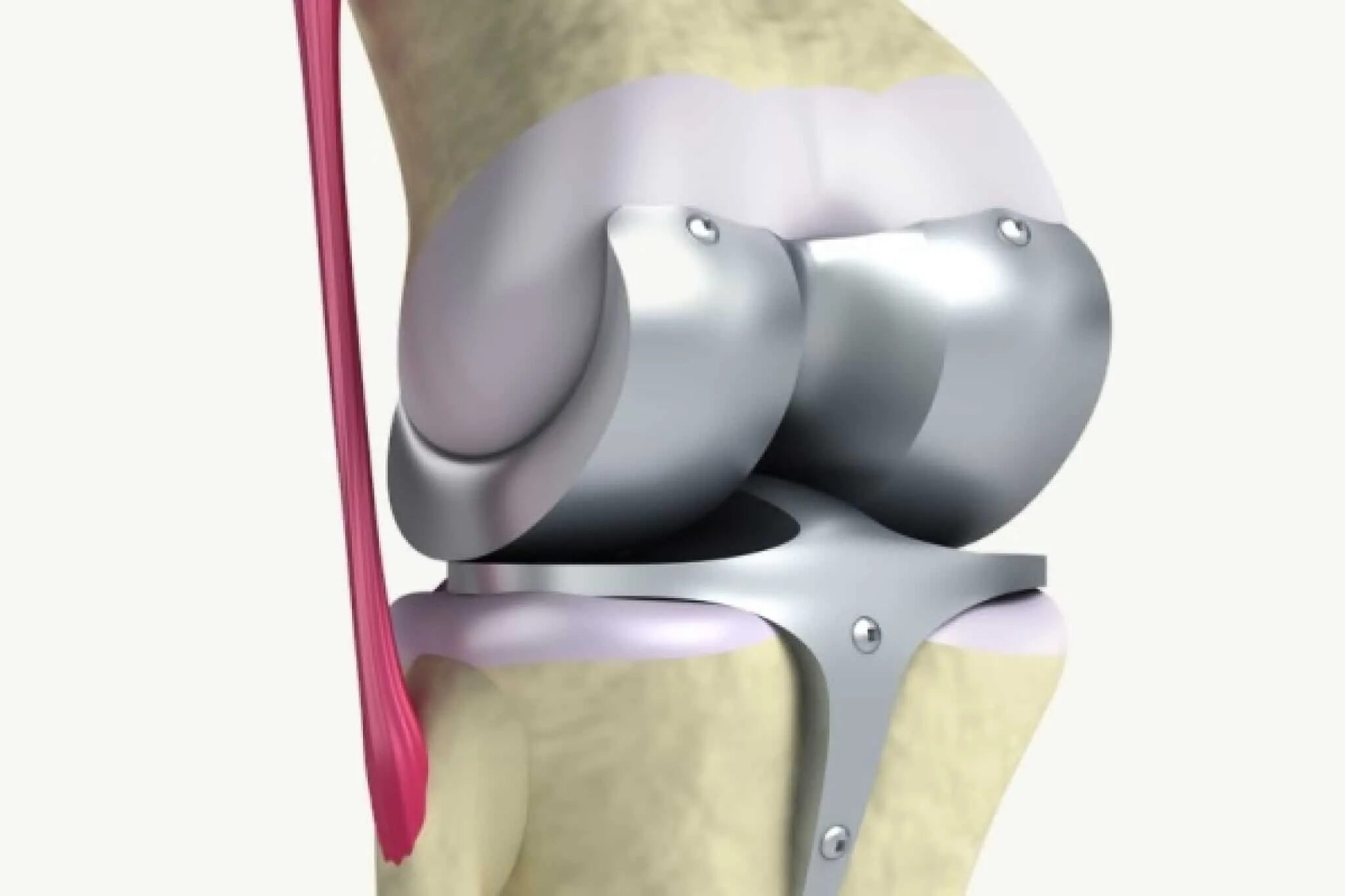 Эндопротез мениска коленного сустава. Артроз коленного сустава эндопротез. Тазобедренный эндопротез Райт. Резекция медиального мениска. Операция по замене коленного сустава москва