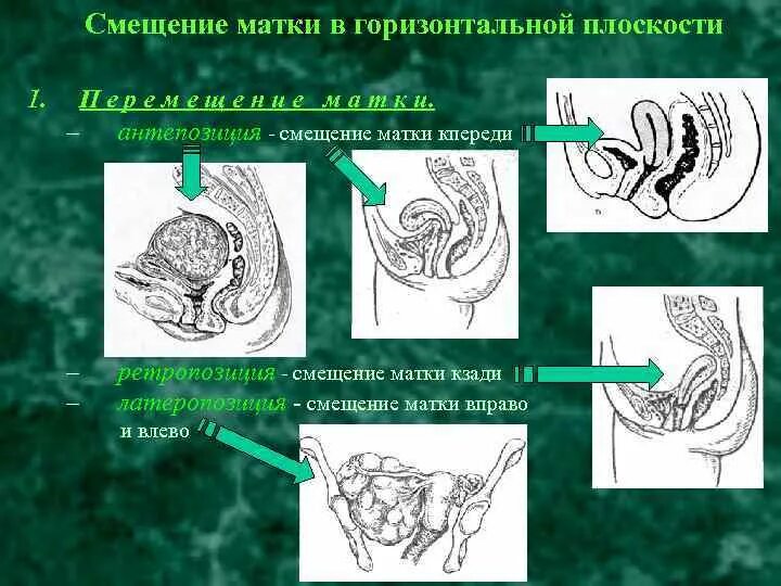 Положение матки. Аномальное расположение матки. смещение матки. неправильное положение матки. матка отклонена вправо.